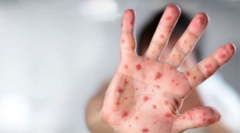 DSÖ Maymun Çiçeği Hastalığının İsmini Değiştiriyor