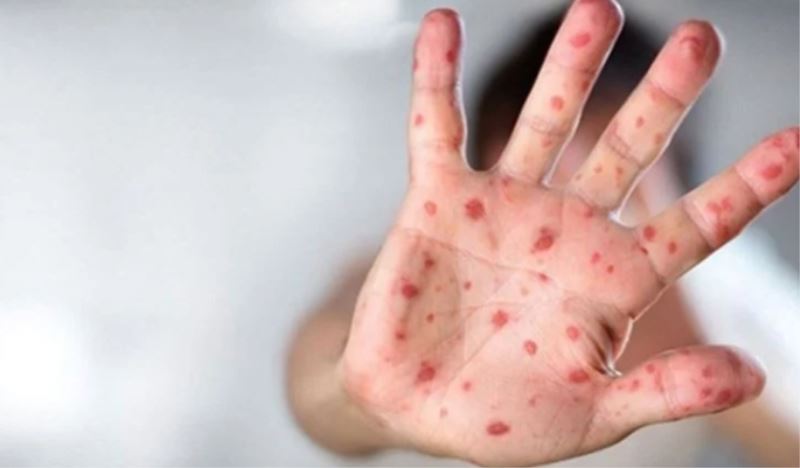 Dünya Genelinde Maymun Çiçeği Salgını Azalma Eğiliminde